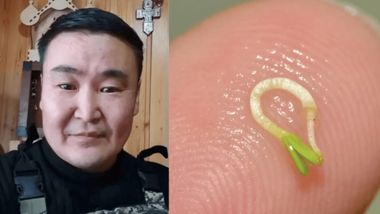 Man Suffered Headaches for Four Months. Doctors Found a Seed Growing Roots in His Eye
