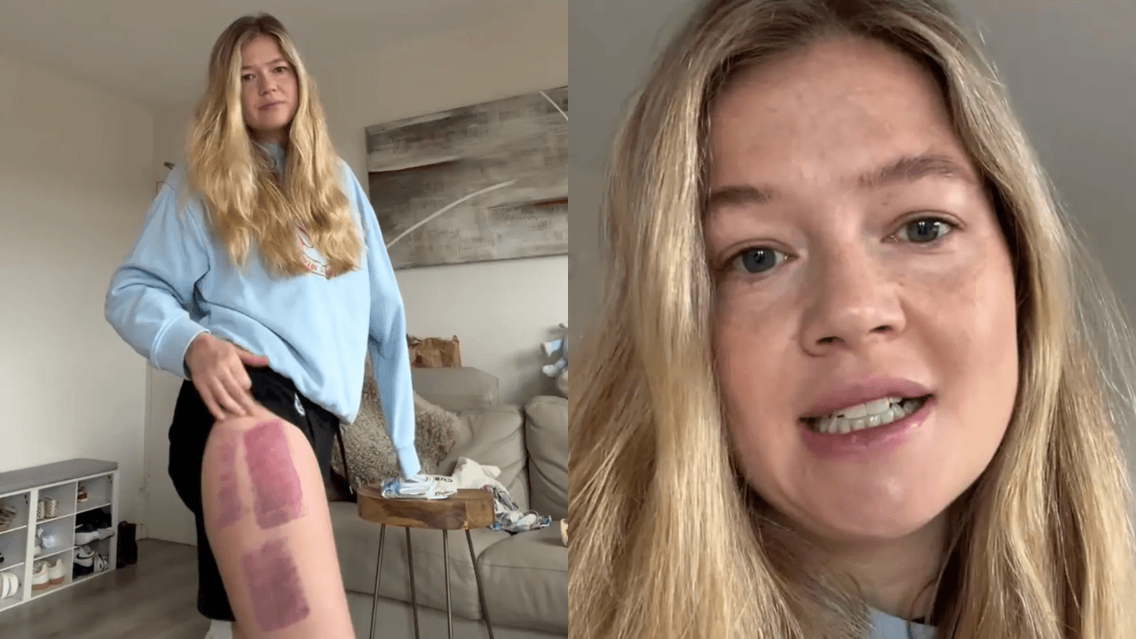 Shark Attack Survivor Leah Stewart Says Second Skin Graft Has Failed