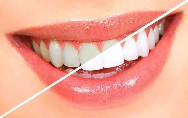 Types Of Teeth Whitening Treatments And How They Work
