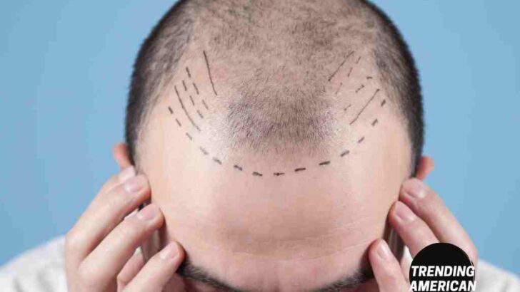 <strong>In what range would you expect to spend money on a FUE hair transplant?</strong>