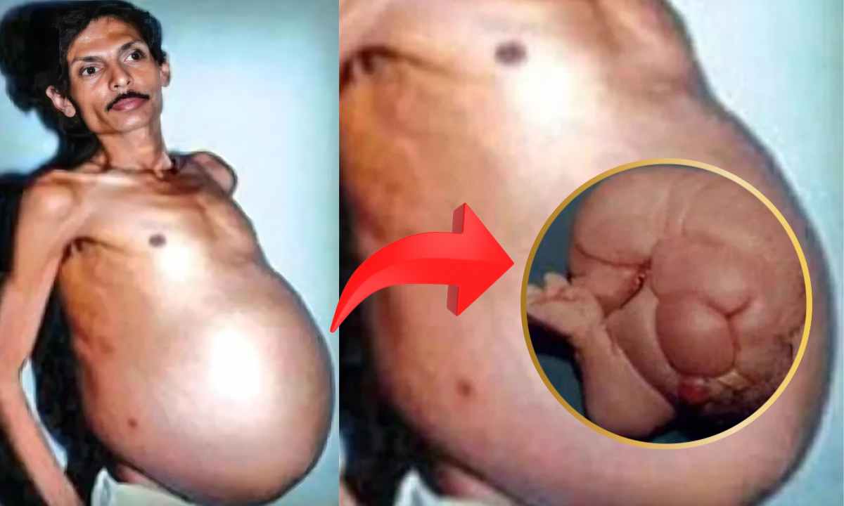 This Man Was Pregnant With His Twin His Twin Grew Inside For 36 Years!