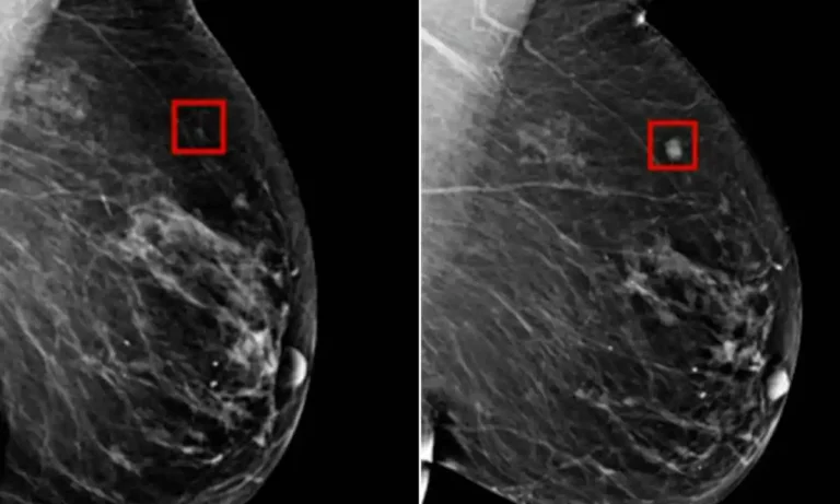 AI Detects Breast Cancer 5 Years In Advance!